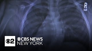 A new app is using AI to treat scoliosis in children without ever leaving home